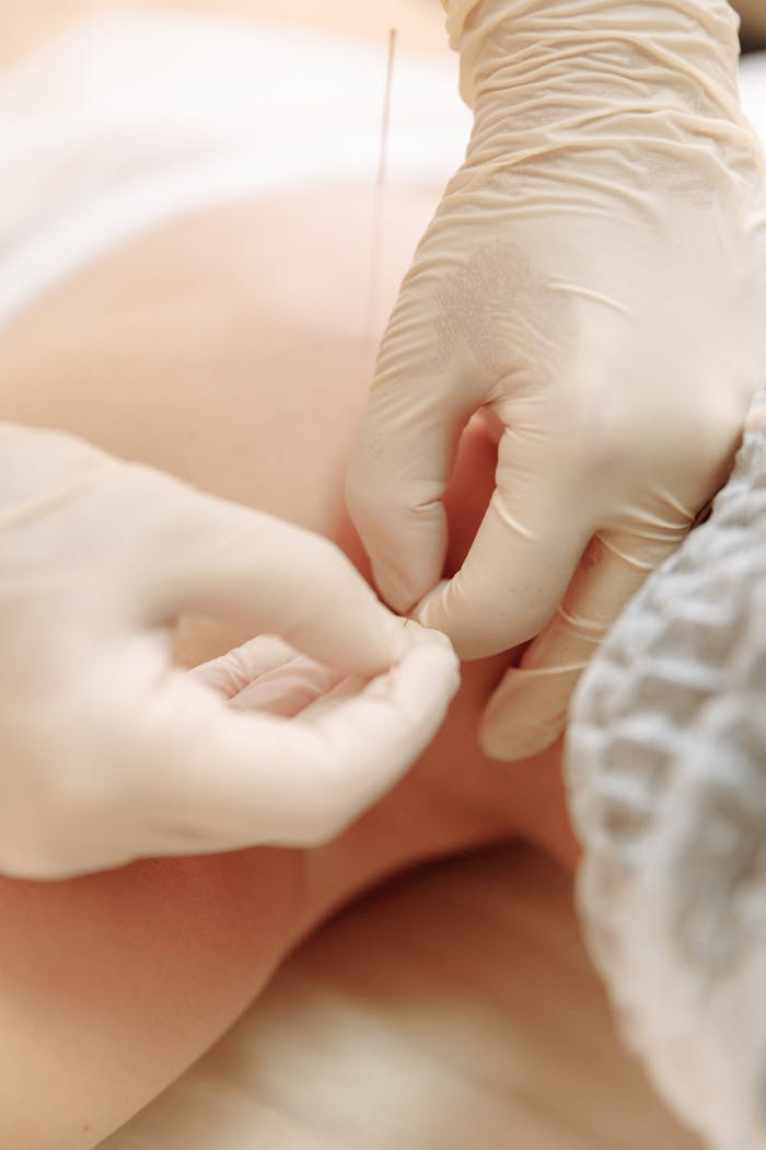 A gloved practitioner inserts needles during an acupuncture session for therapeutic treatment.